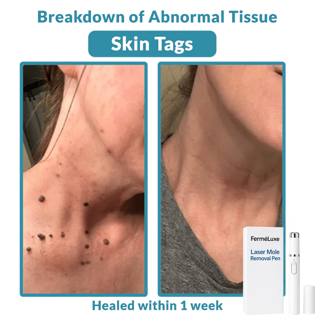 Non-Invasive Mole and Wart Removal Laser Pen